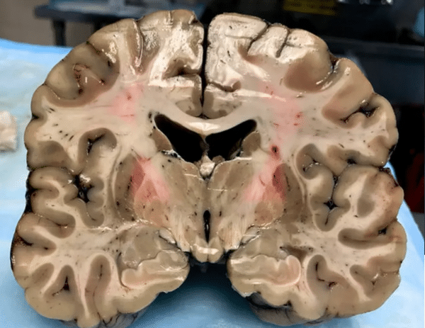 Dr Funchal: Trauma na cabeça – a concussão ou contusão cerebral